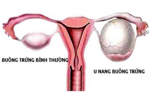 Đau vùng chậu khi quan hệ do u nang buồng trứng